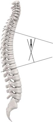 The Clinical Relevance of Hyperkyphosis: A Narrative Review